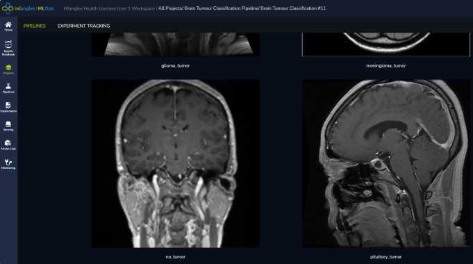 Brain Tumor Classification